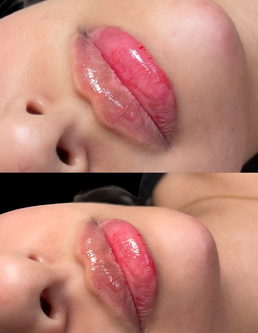 Russian Lip Filler: Understanding the Technique, Results & What to Expect
