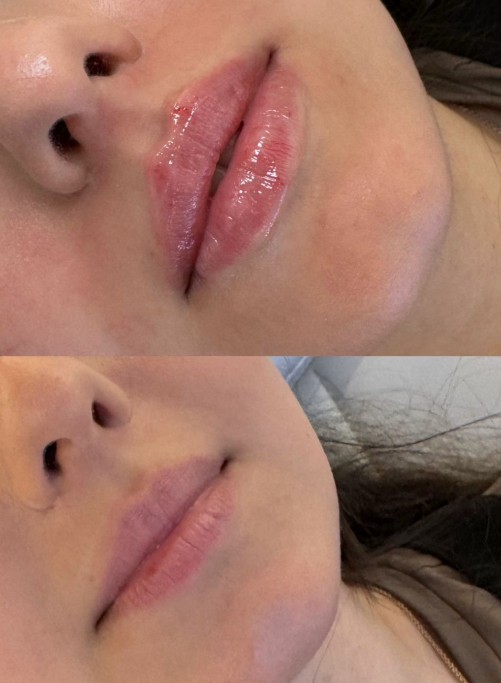 The Flat Lip Technique: A Modern Approach to Natural Lip Enhancement