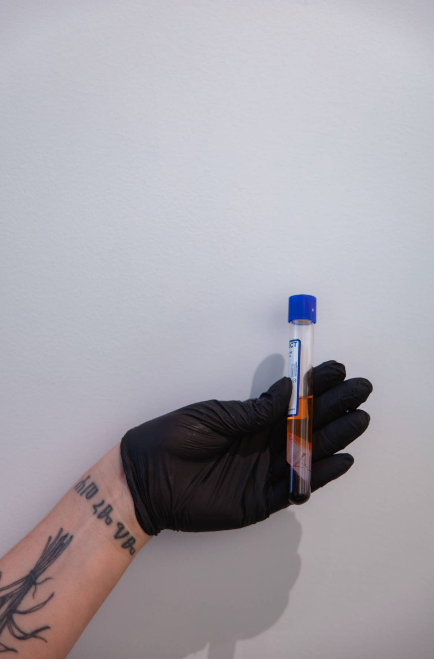 PRP Hair Restoration