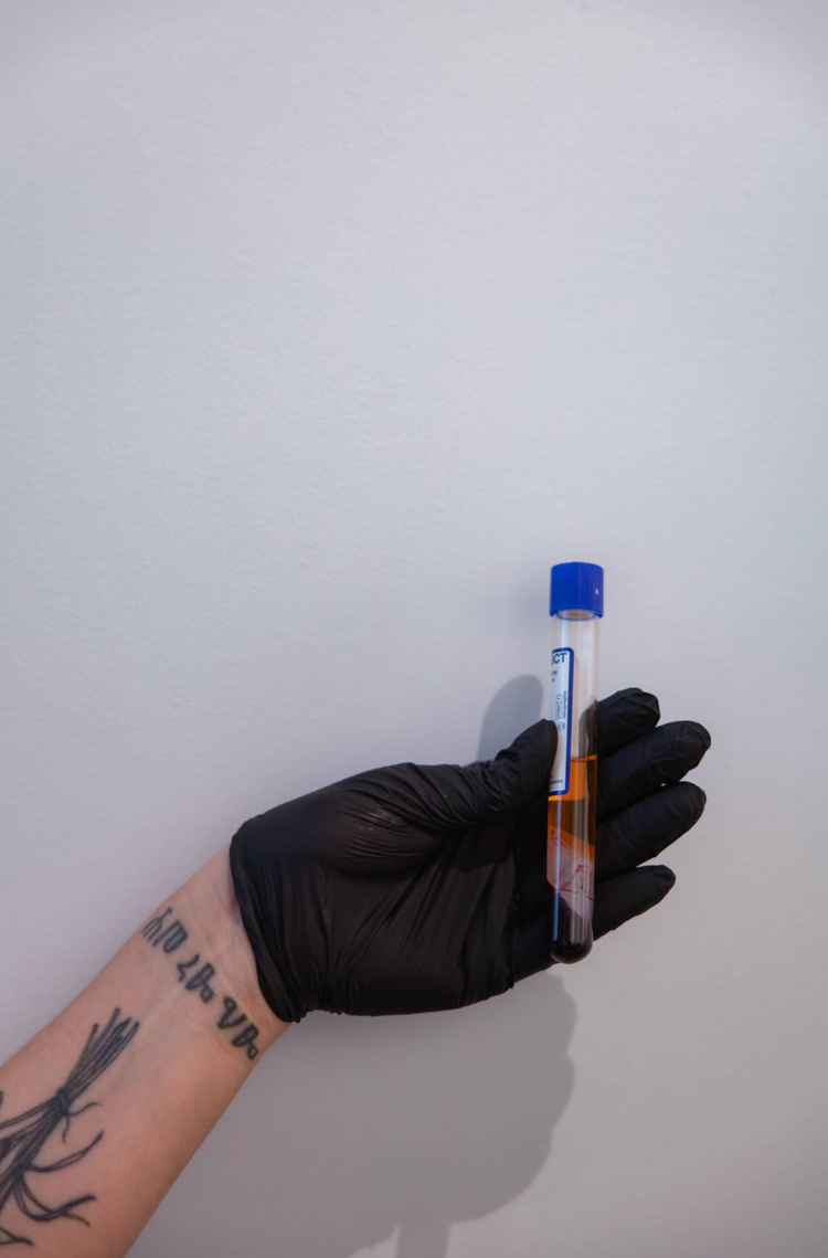 PRP Hair Restoration