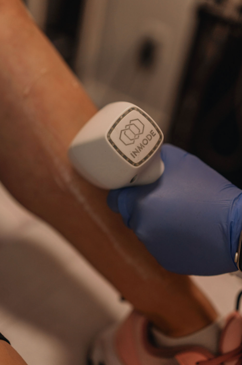 Laser Hair Removal