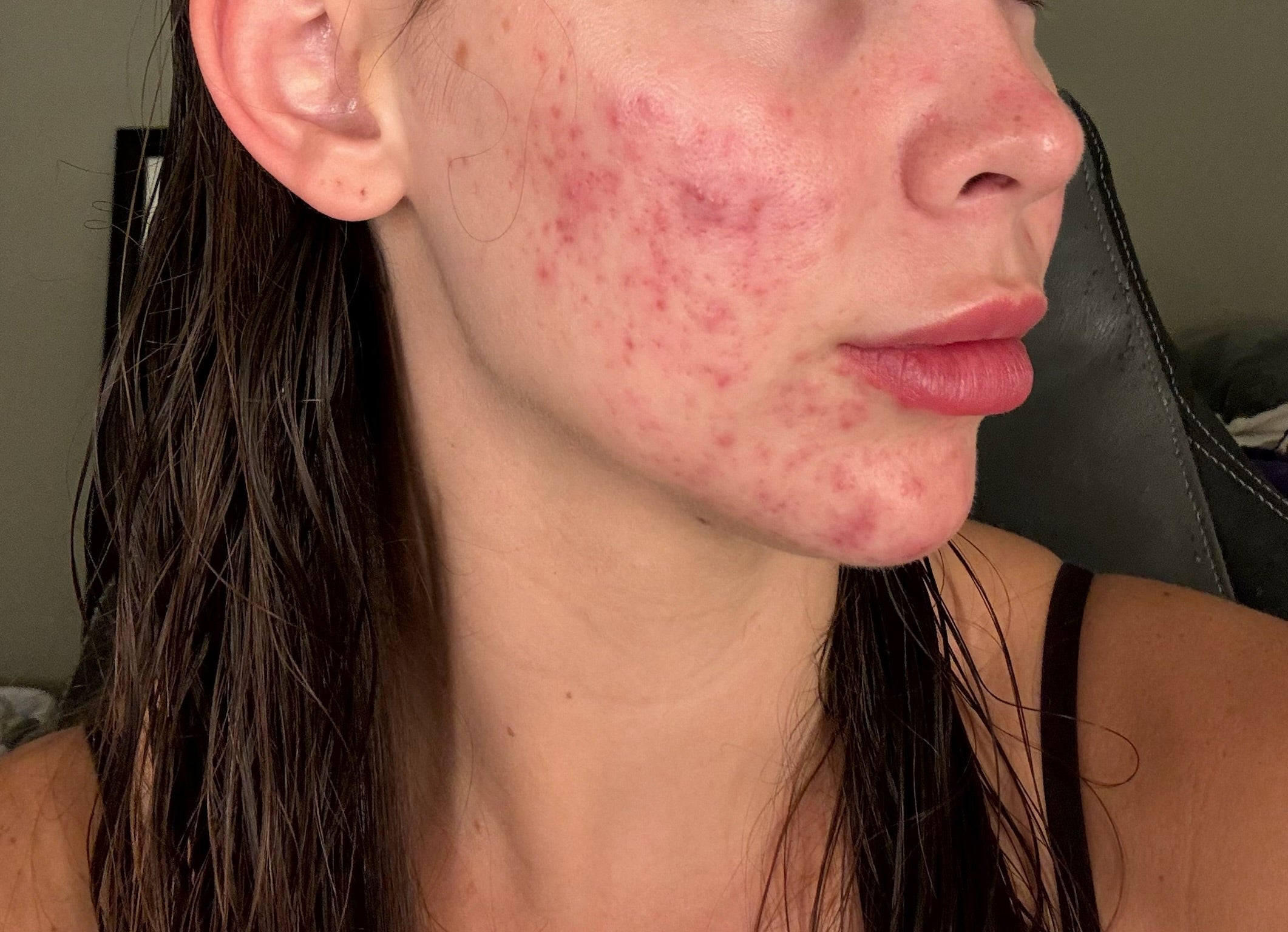 Close-up side profile of a client's cheek and jawline before a skin treatment at KOZA Skin Clinic, Port Coquitlam, Tri-Cities BC