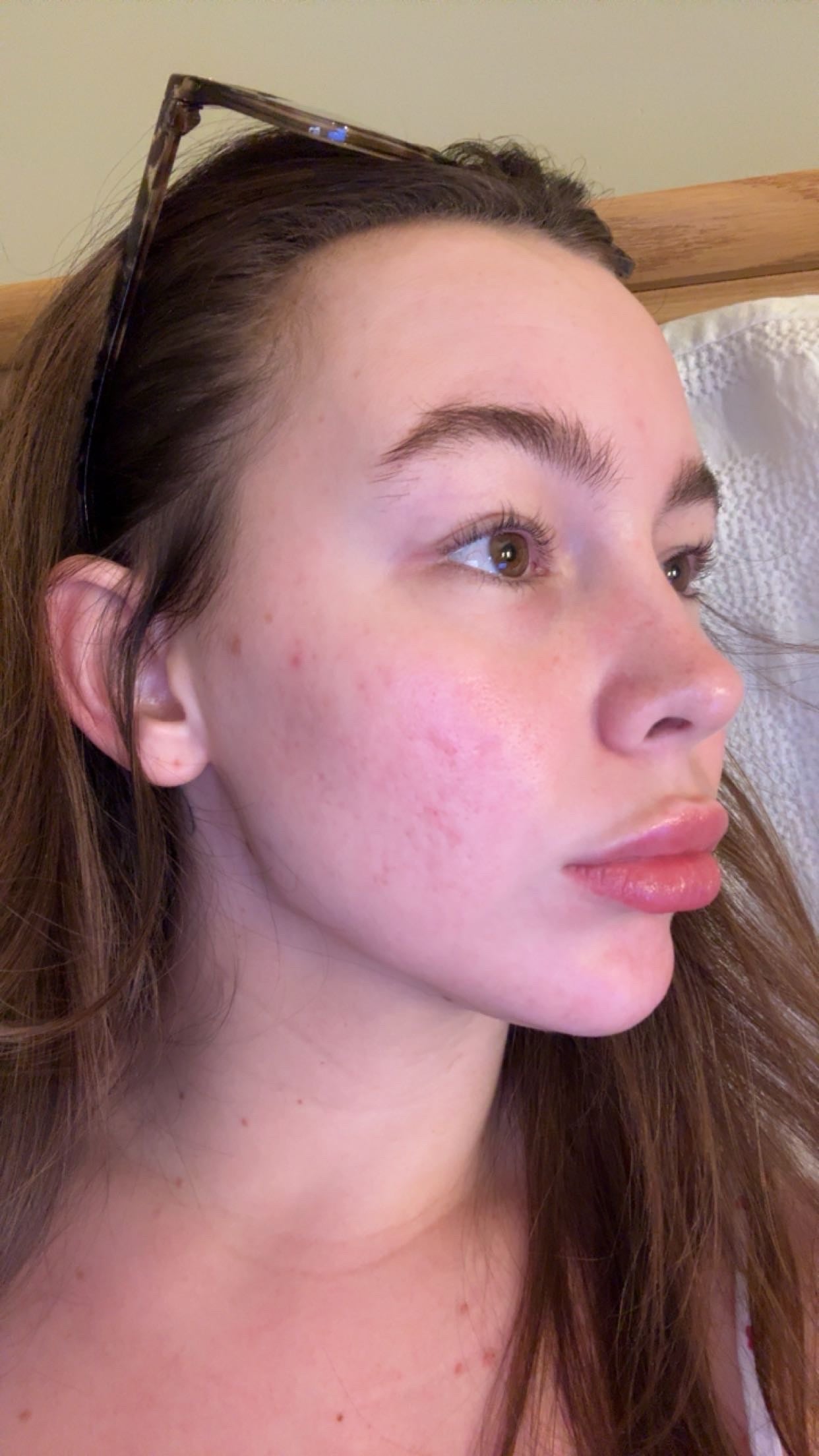 Side profile of a client's face showing skin texture and redness on the cheek before a skin treatment at KOZA Skin Clinic, Port Coquitlam, Tri-Cities BC