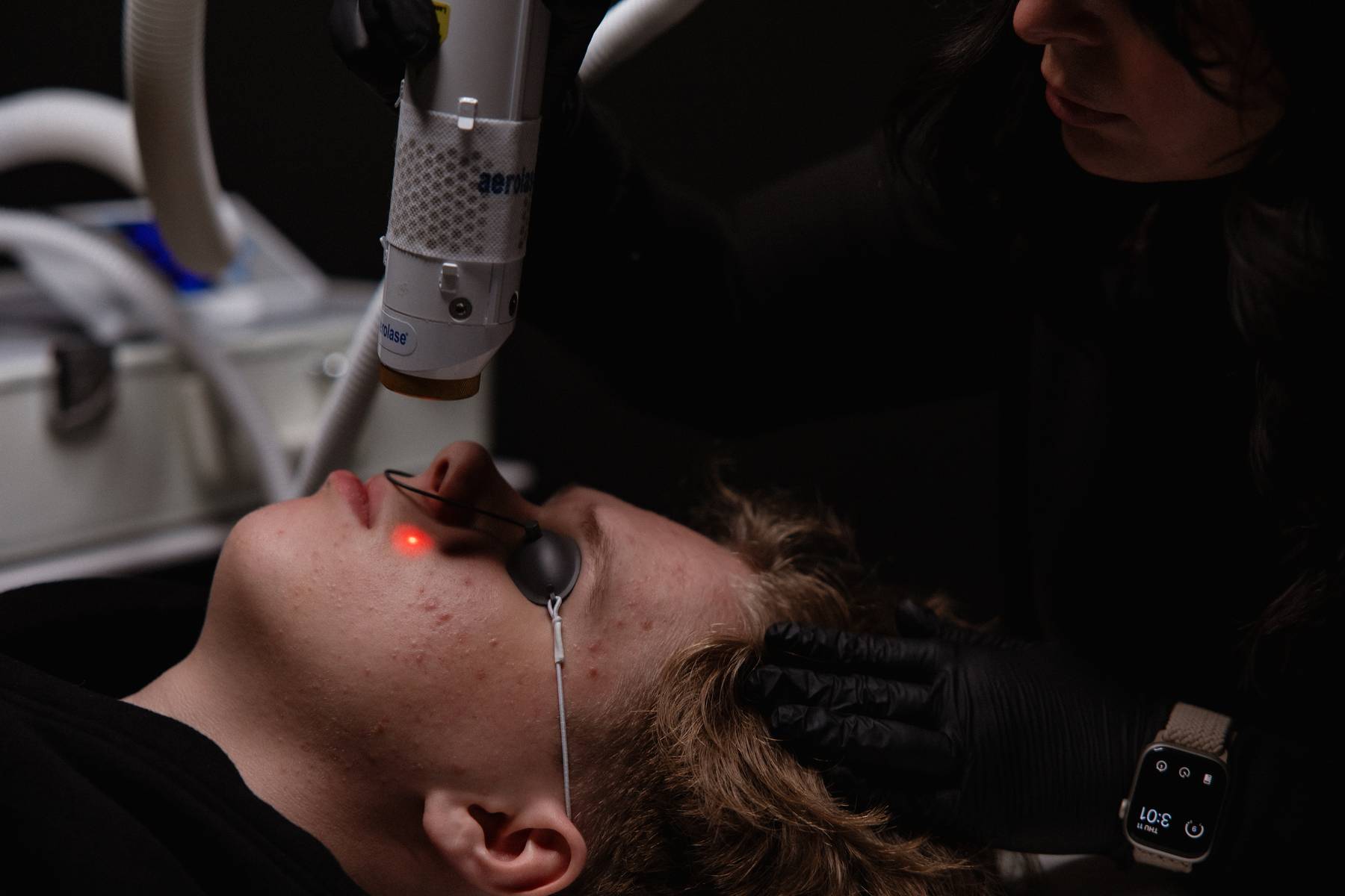Client wearing protective eye shields receiving an Aerolase Neo laser treatment on the face at KOZA Skin Clinic, Port Coquitlam, Tri-Cities BC