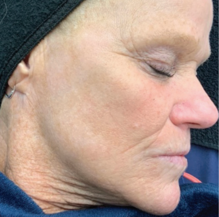 Side profile of a client's face after a BBL Forever Young photofacial treatment at KOZA Skin Clinic, Port Coquitlam, Tri-Cities BC.