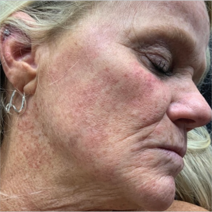 Side profile of a client's face with sun spots and pigmentation before a BBL Forever Young photofacial treatment at KOZA Skin Clinic, Port Coquitlam, Tri-Cities BC.