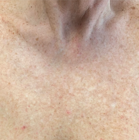 Close-up of the neck and chest skin after a BBL photofacial treatment at KOZA Skin Clinic, Port Coquitlam, Tri-Cities BC.