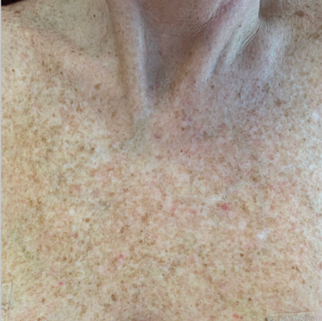 Close-up of the neck and chest skin with sun spots and pigmentation before a BBL photofacial treatment at KOZA Skin Clinic, Port Coquitlam, Tri-Cities BC.
