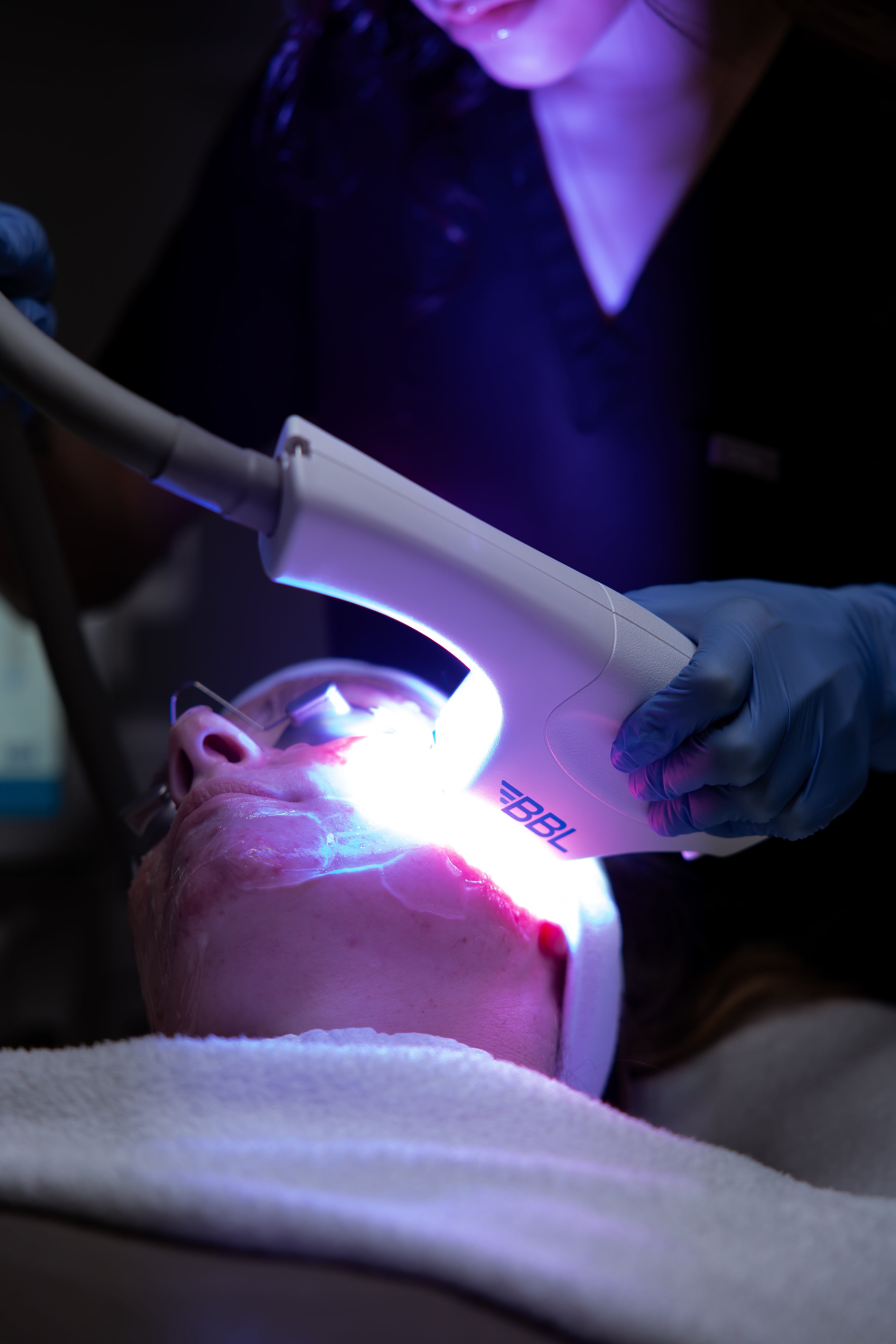 Client receiving a BBL photofacial treatment with bright light on the face at KOZA Skin Clinic, Port Coquitlam, Tri-Cities BC.