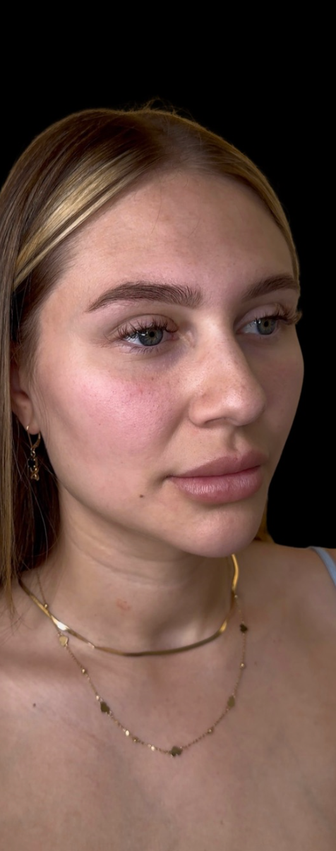 Close-up portrait of a client's face showing cheek skin tone and complexion for a skin treatment consultation at KOZA Skin Clinic, Port Coquitlam, Tri-Cities BC