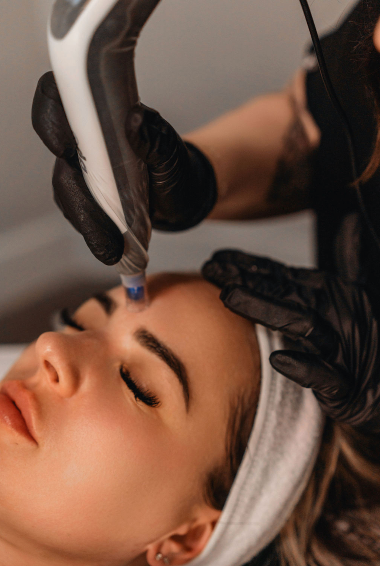 Clinician performing a DP4 Dermapen microneedling treatment on a client's forehead at KOZA Skin Clinic, Port Coquitlam, Tri-Cities BC