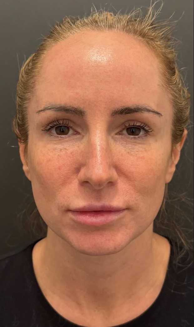 Front-facing after photo of a client's face following a DP4 microneedling treatment at KOZA Skin Clinic, Port Coquitlam, Tri-Cities BC