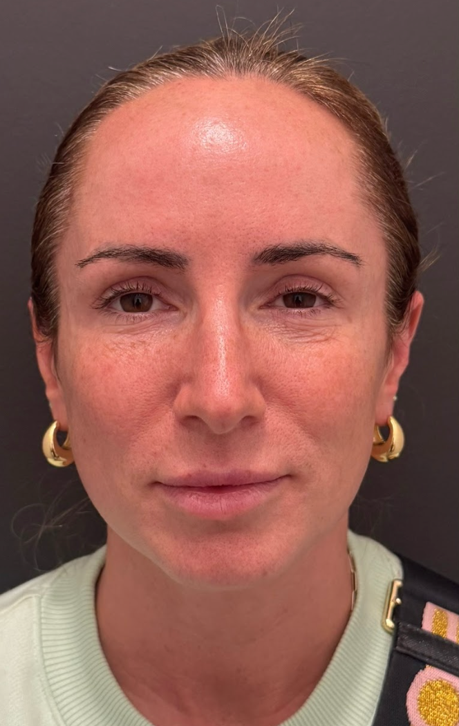 Front-facing before photo of a client's face showing skin texture prior to a DP4 microneedling treatment at KOZA Skin Clinic, Port Coquitlam, Tri-Cities BC