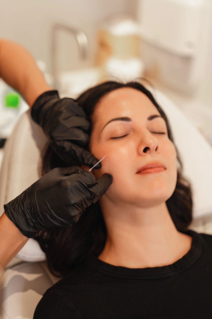 Dermal filler treatment by a gloved practitioner at KOZA Skin Clinic, Port Coquitlam, Tri-Cities BC.