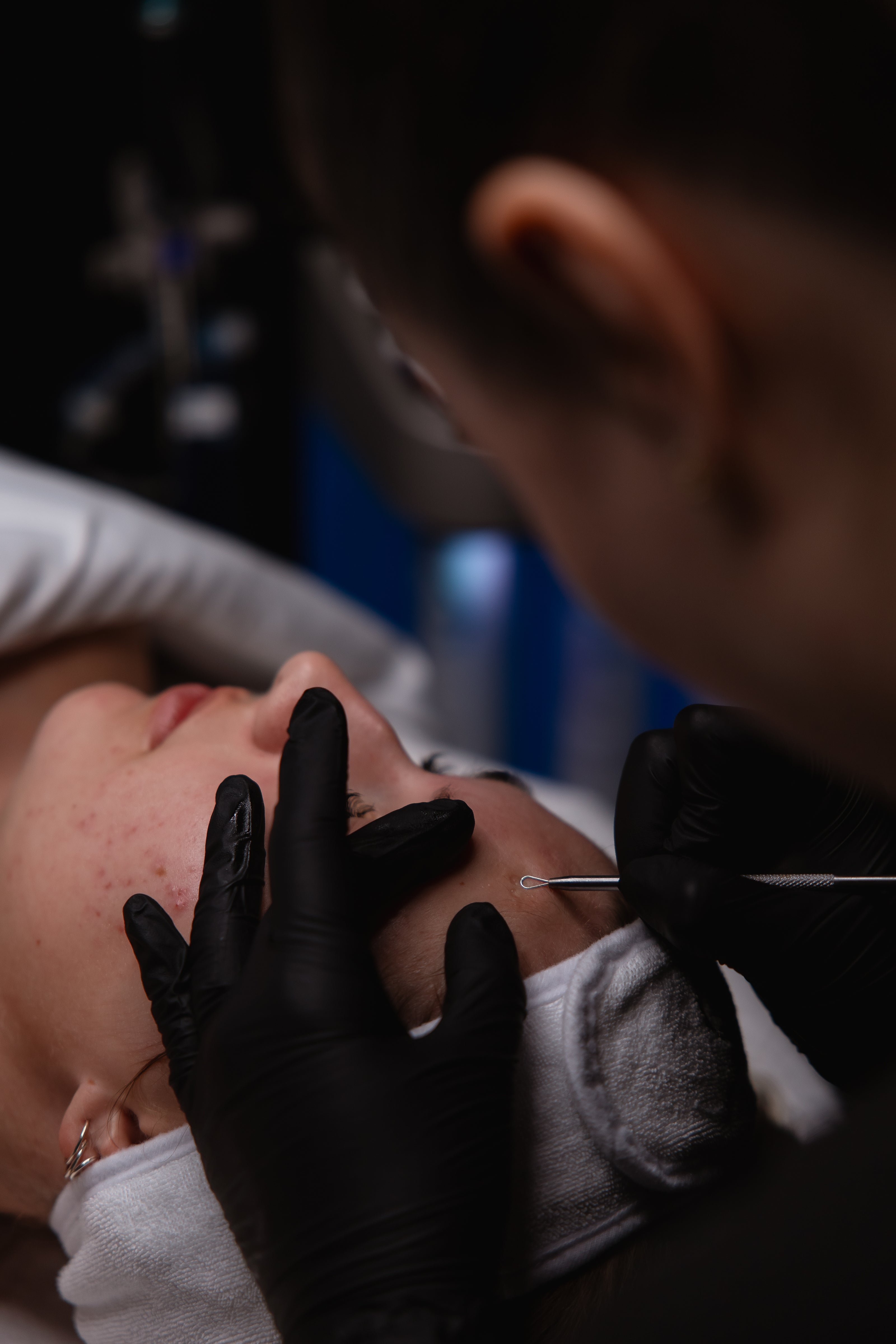 Close-up of an esthetician performing facial extractions with a fine tool on a client at KOZA Skin Clinic, Port Coquitlam, Tri-Cities BC.