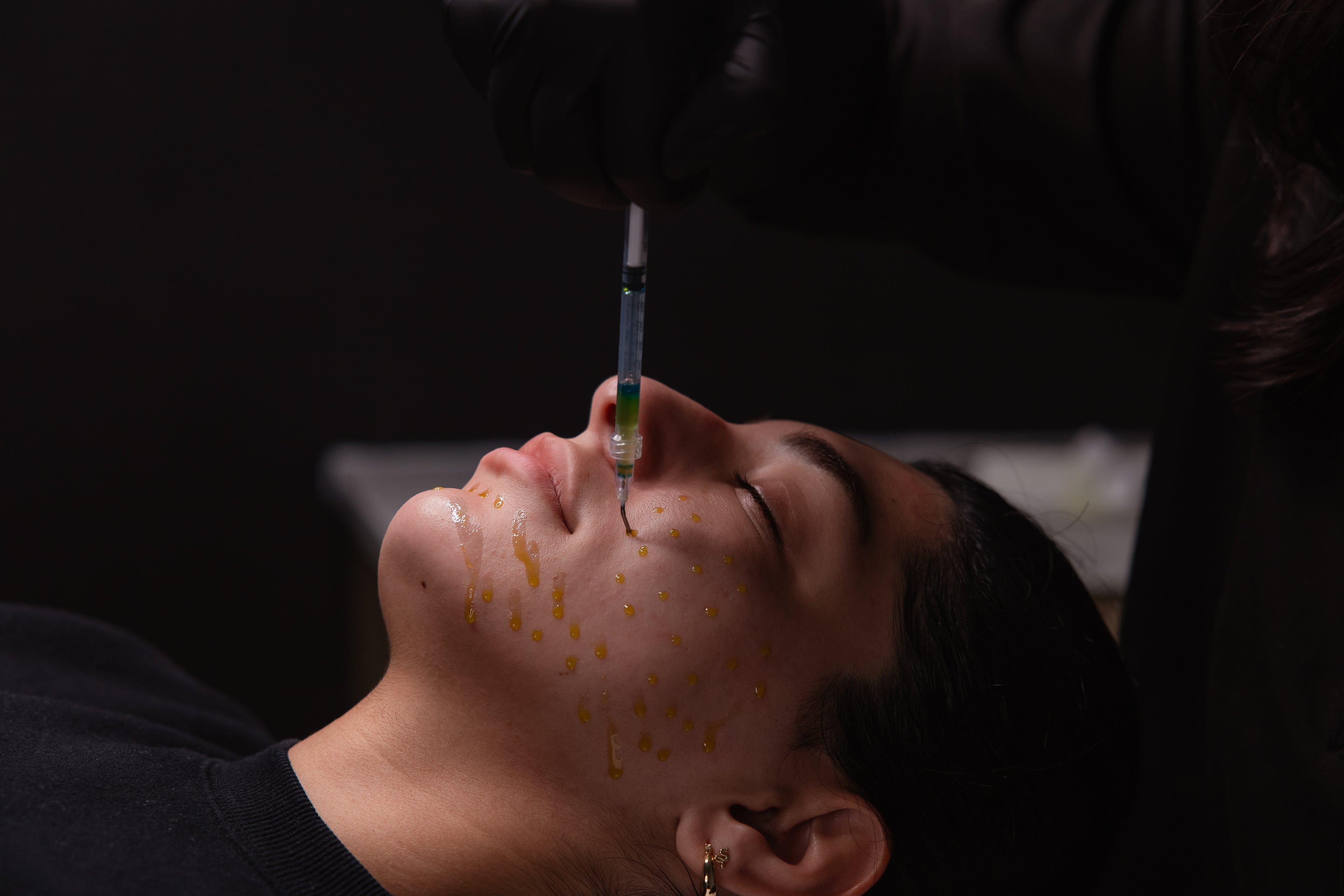 Close-up of a client receiving a facial injectable treatment with a syringe at KOZA Skin Clinic, Port Coquitlam, Tri-Cities BC.