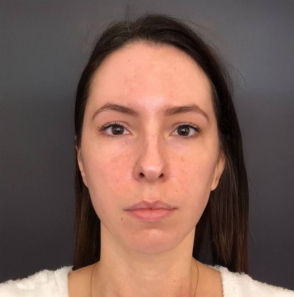 Front-facing clinical portrait of a client's face for a skin assessment at KOZA Skin Clinic, Port Coquitlam, Tri-Cities BC