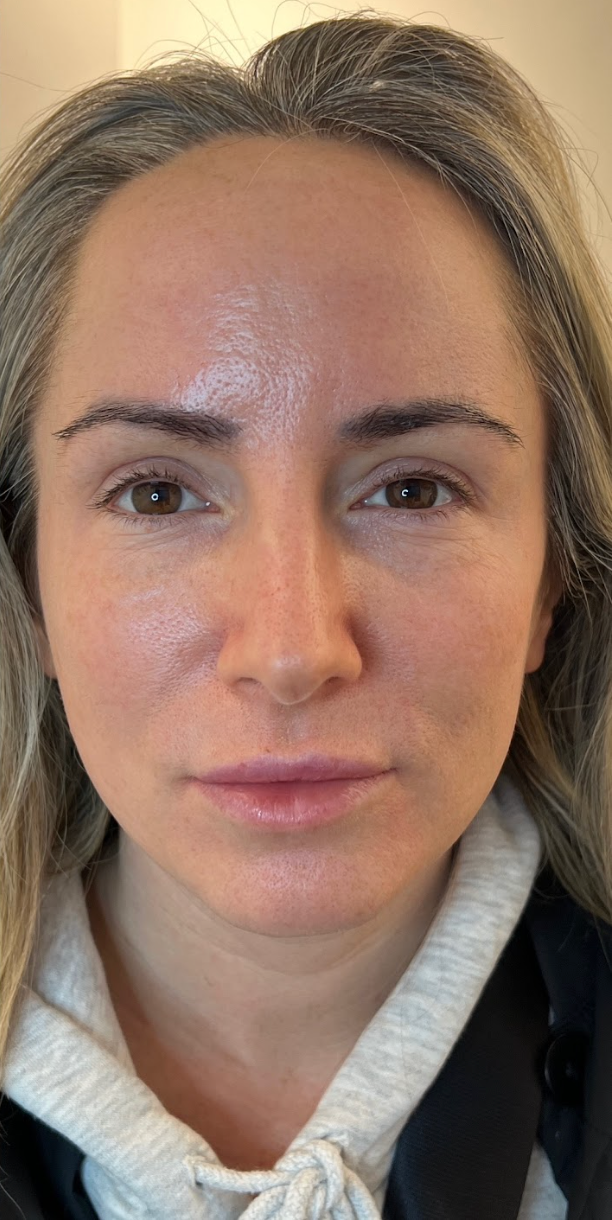 Front-facing portrait of a client's face showing skin tone and texture for a skin treatment consultation at KOZA Skin Clinic, Port Coquitlam, Tri-Cities BC