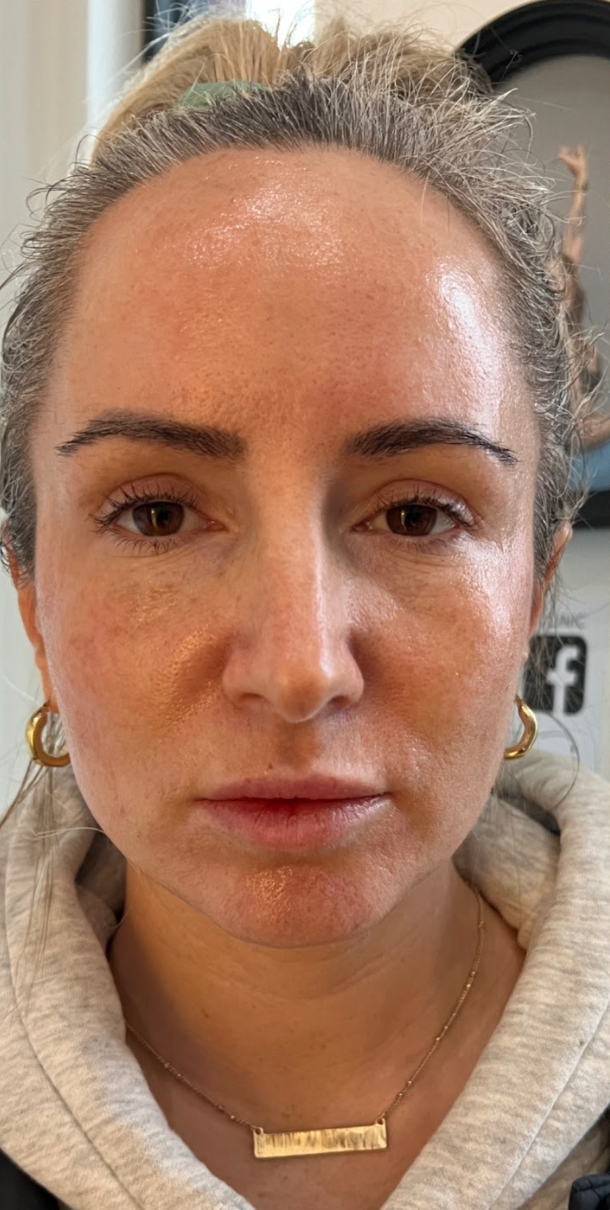 Front-facing portrait of a client's face showing natural skin texture and pigmentation before a skin treatment at KOZA Skin Clinic, Port Coquitlam, Tri-Cities BC