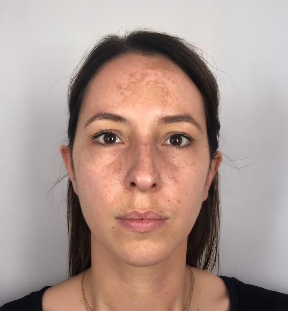 Front-facing clinical portrait of a client's face showing pigmentation before a skin treatment at KOZA Skin Clinic, Port Coquitlam, Tri-Cities BC