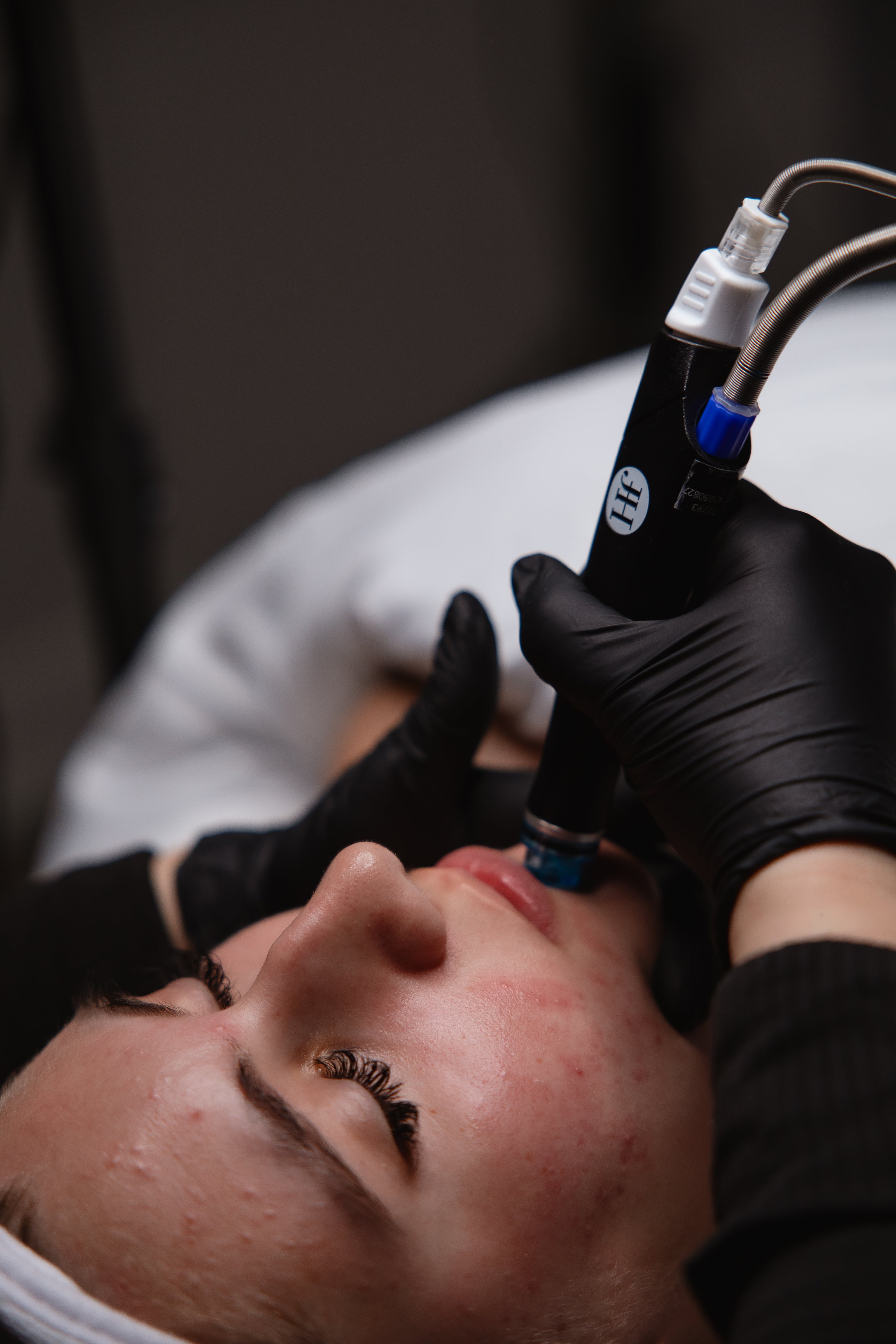 Clinician performing a HydraFacial treatment on a reclining client's cheek with a handheld device at KOZA Skin Clinic, Port Coquitlam, Tri-Cities BC