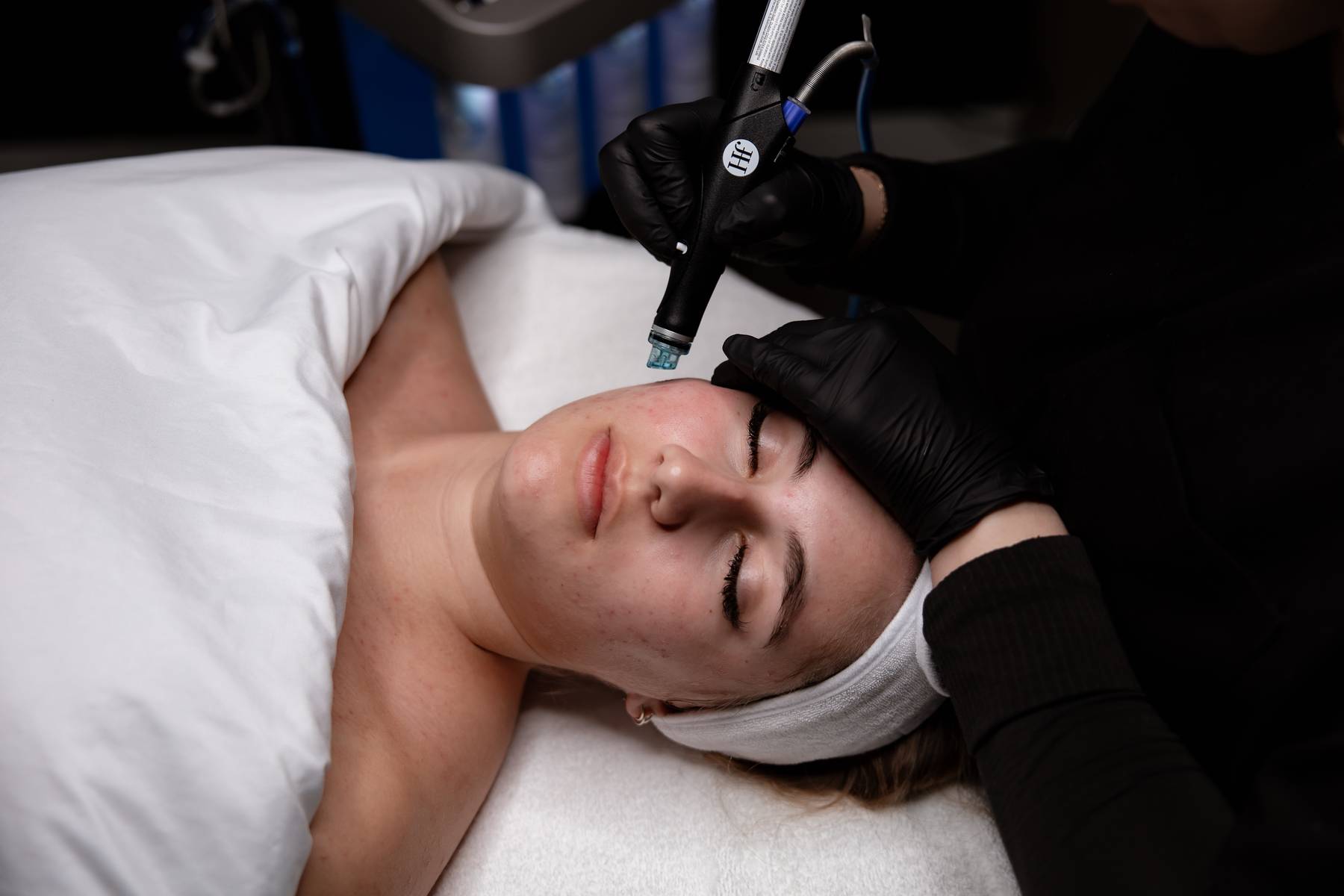 Client receiving a HydraFacial treatment on the forehead at KOZA Skin Clinic, Port Coquitlam, Tri-Cities BC.
