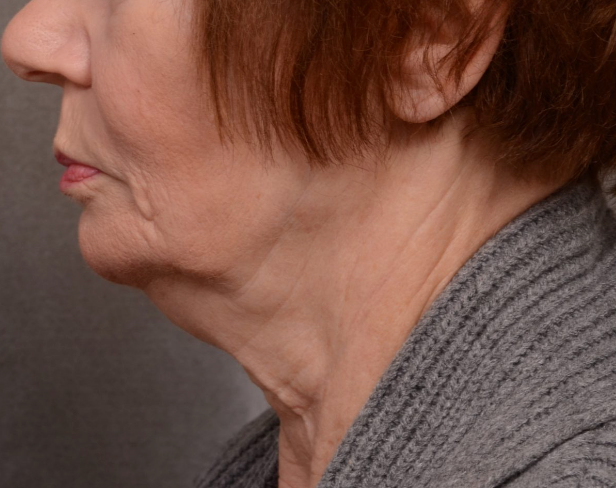 Side profile of the lower face, jawline and neck showing skin laxity at KOZA Skin Clinic, Port Coquitlam, Tri-Cities BC.