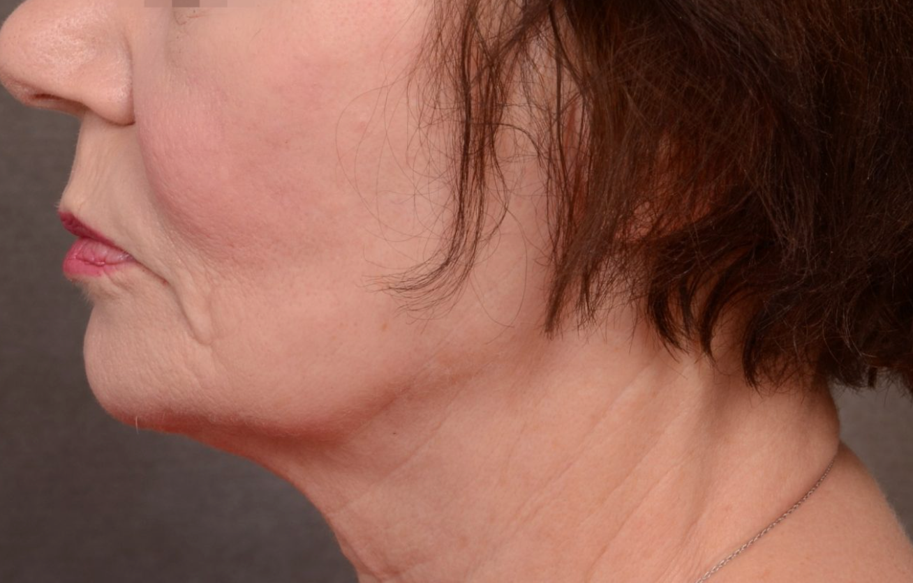 Side profile of the lower face, jawline and neck at KOZA Skin Clinic, Port Coquitlam, Tri-Cities BC.