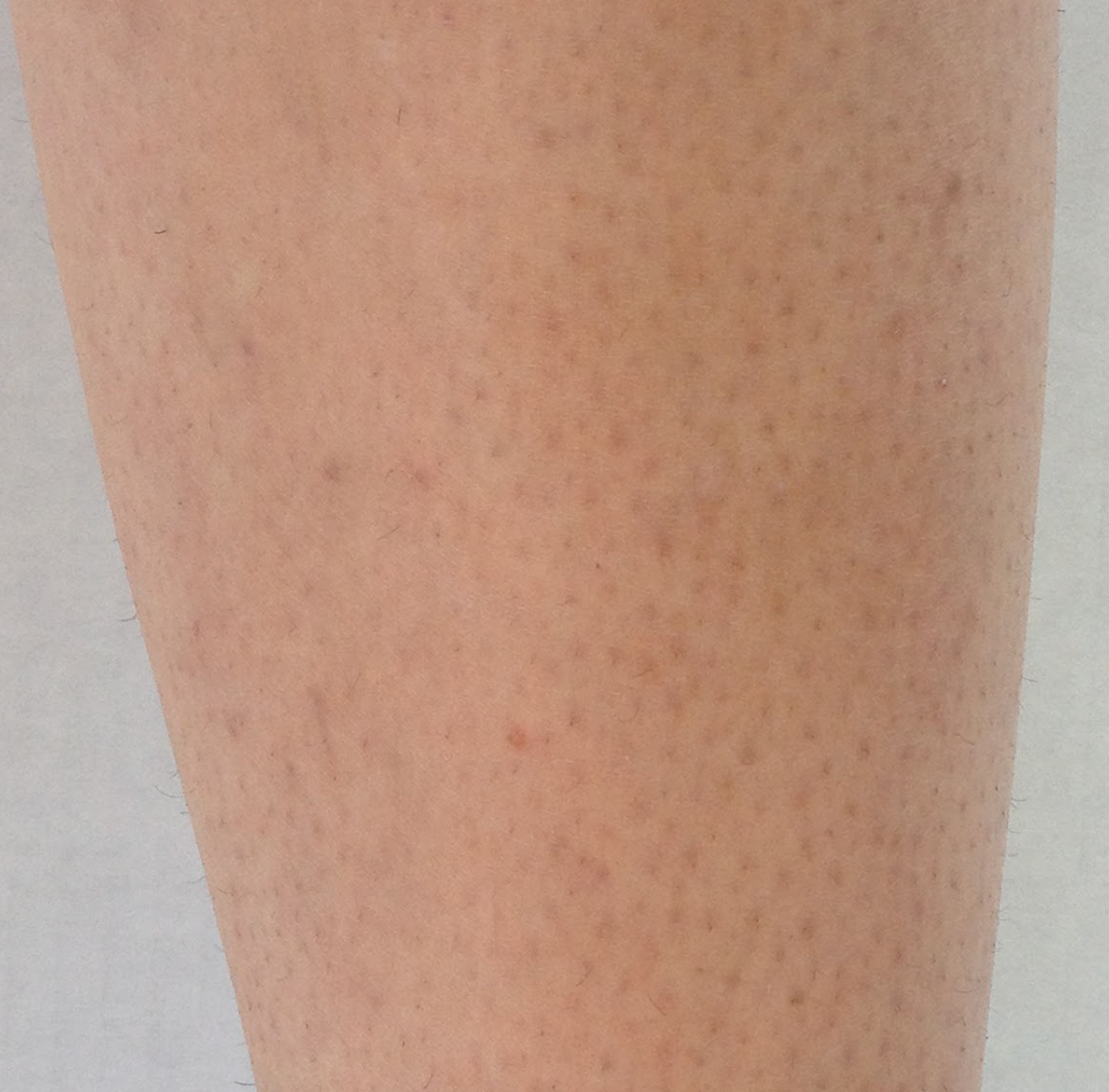 Close-up of skin with visible hair follicles after a laser hair removal treatment at KOZA Skin Clinic, Port Coquitlam, Tri-Cities BC.