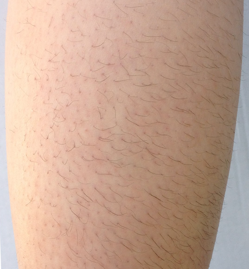 Close-up of skin with visible hair before a laser hair removal treatment at KOZA Skin Clinic, Port Coquitlam, Tri-Cities BC.