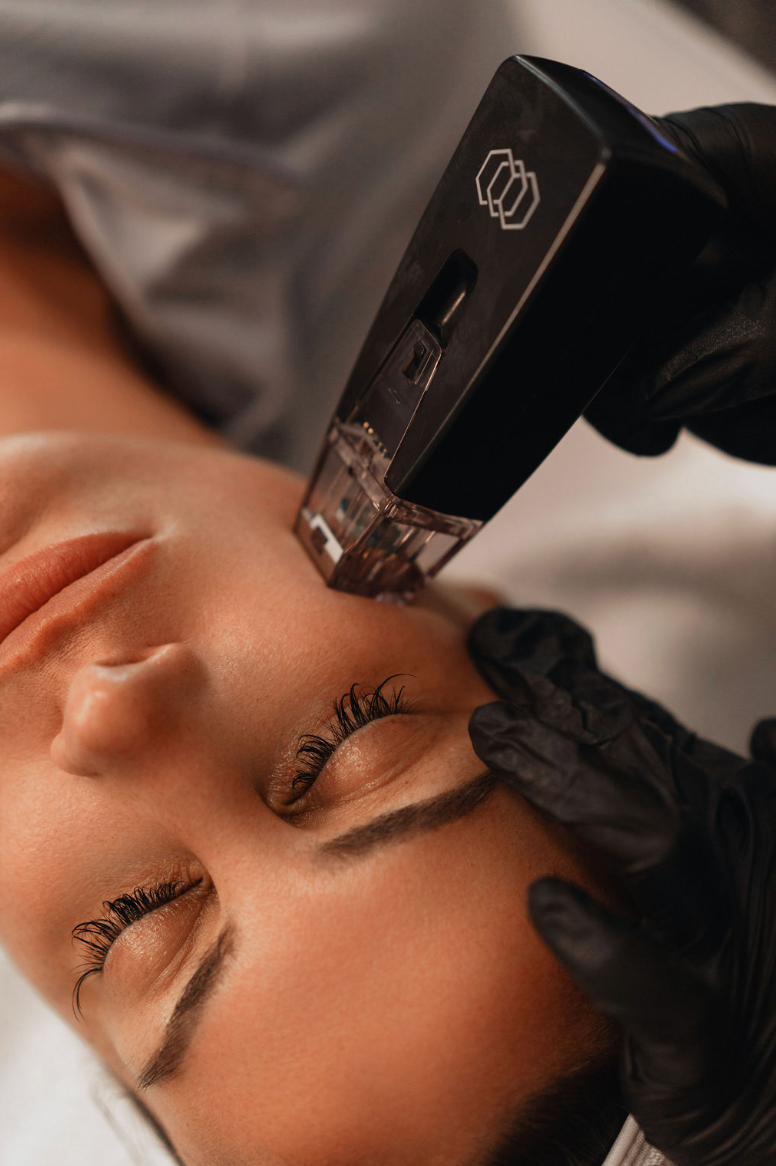 Morpheus8 handpiece applied to a client's forehead during a skin treatment at KOZA Skin Clinic, Port Coquitlam, Tri-Cities BC.