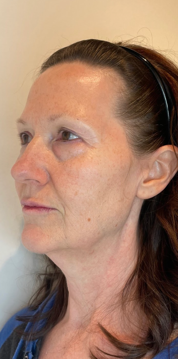 Side profile of a client's face after a Morpheus8 skin treatment at KOZA Skin Clinic, Port Coquitlam, Tri-Cities BC.
