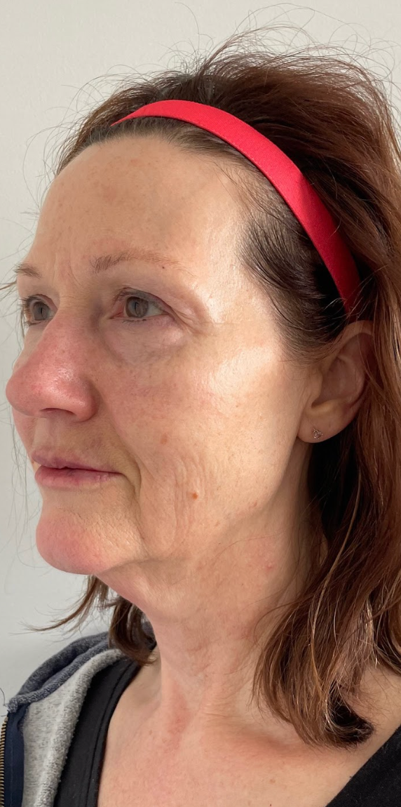 Side profile of a client's face before a Morpheus8 skin treatment at KOZA Skin Clinic, Port Coquitlam, Tri-Cities BC.