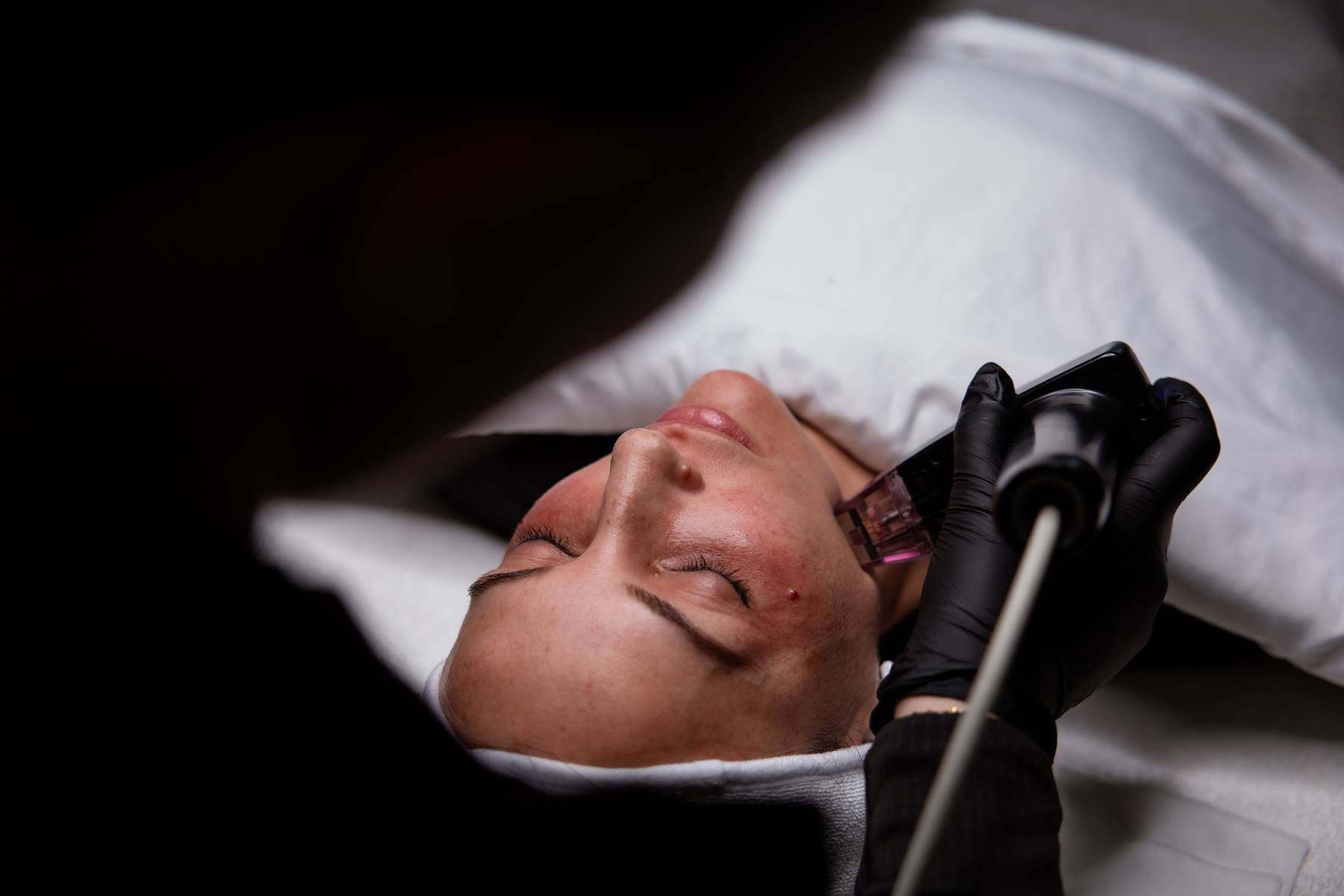 Client receiving a Morpheus8 skin treatment on the cheek at KOZA Skin Clinic, Port Coquitlam, Tri-Cities BC.