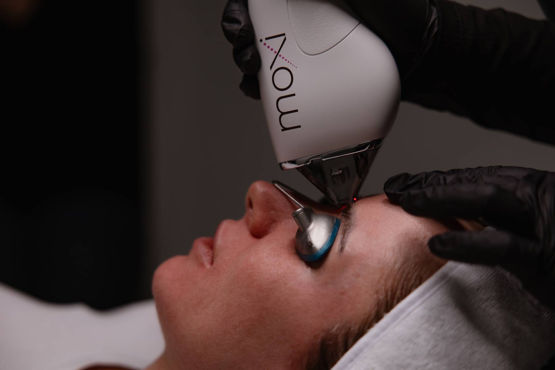 Moxi laser handpiece applied to a client's cheek during a skin treatment at KOZA Skin Clinic, Port Coquitlam, Tri-Cities BC.