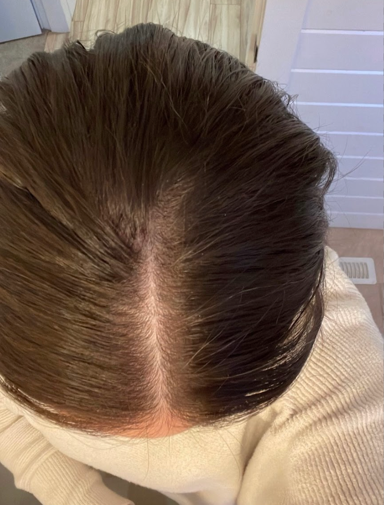 Top-down view of the scalp and hair part after PRP hair restoration treatment at KOZA Skin Clinic, Port Coquitlam, Tri-Cities BC.