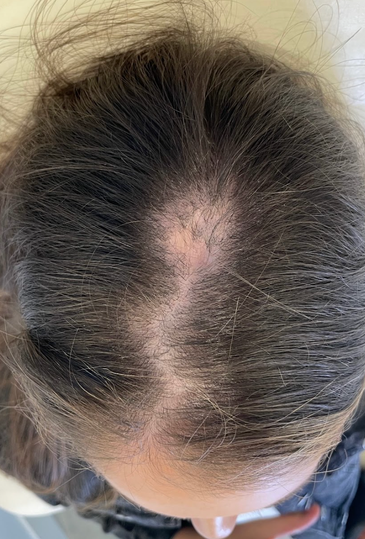 Top-down view of the scalp with thinning hair before PRP hair restoration treatment at KOZA Skin Clinic, Port Coquitlam, Tri-Cities BC.