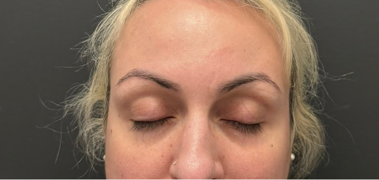Front-facing portrait of a client's face for a skin treatment at KOZA Skin Clinic, Port Coquitlam, Tri-Cities BC.