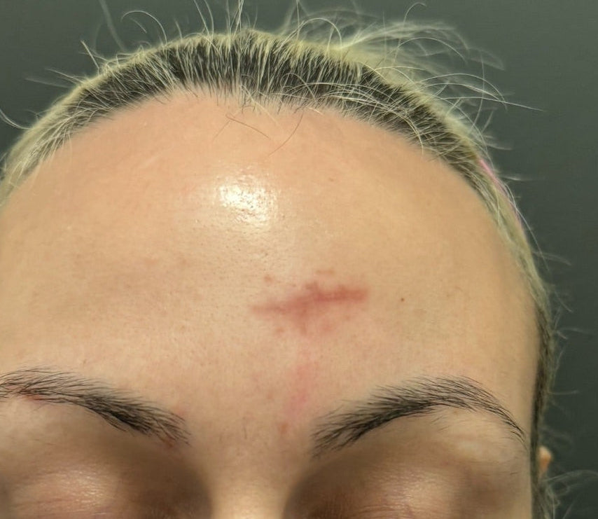 Front-facing portrait of a client's forehead before a skin treatment at KOZA Skin Clinic, Port Coquitlam, Tri-Cities BC.