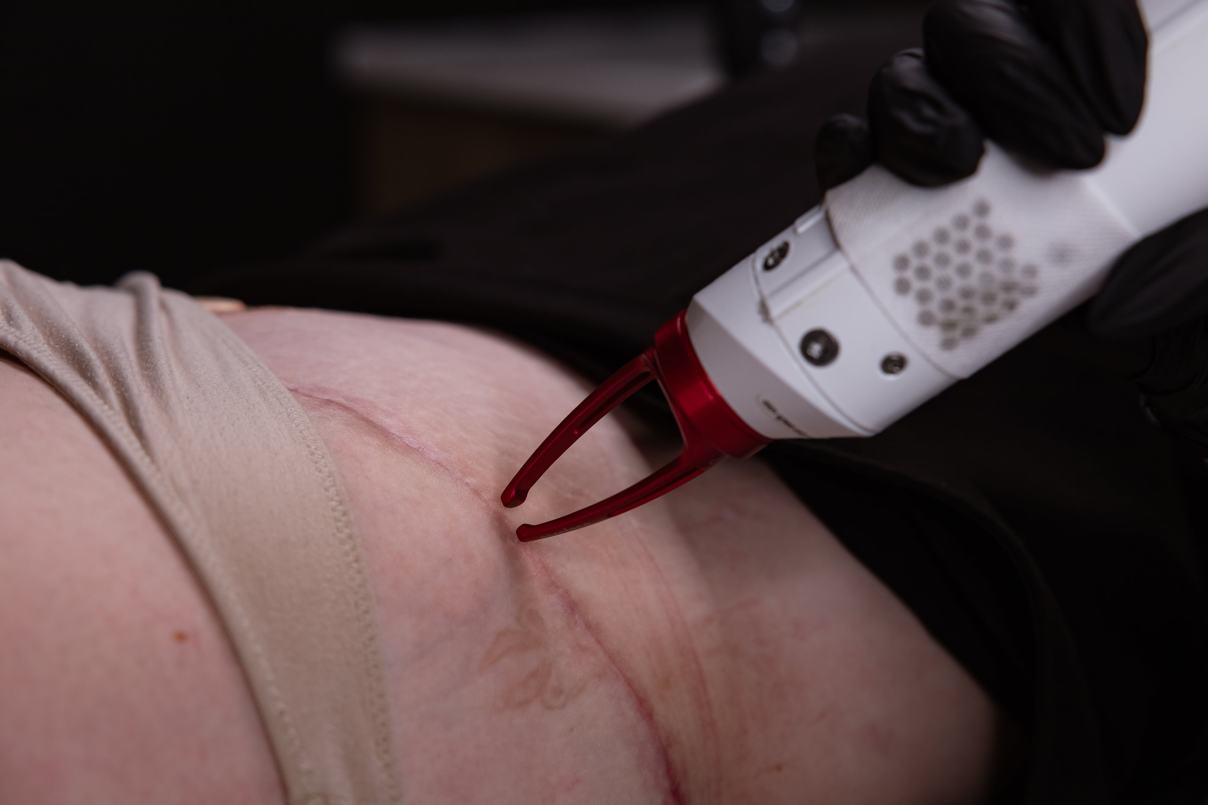 Laser skin treatment with a handheld device at KOZA Skin Clinic, Port Coquitlam, Tri-Cities BC.