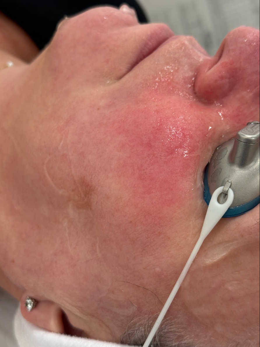 Close-up of the cheek after a vascular treatment at KOZA Skin Clinic, Port Coquitlam, Tri-Cities BC.