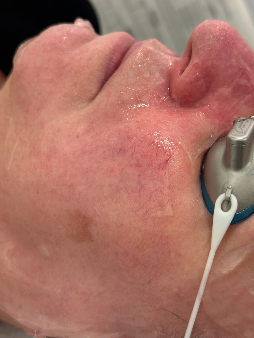 Close-up of the cheek and nose before a vascular treatment at KOZA Skin Clinic, Port Coquitlam, Tri-Cities BC.