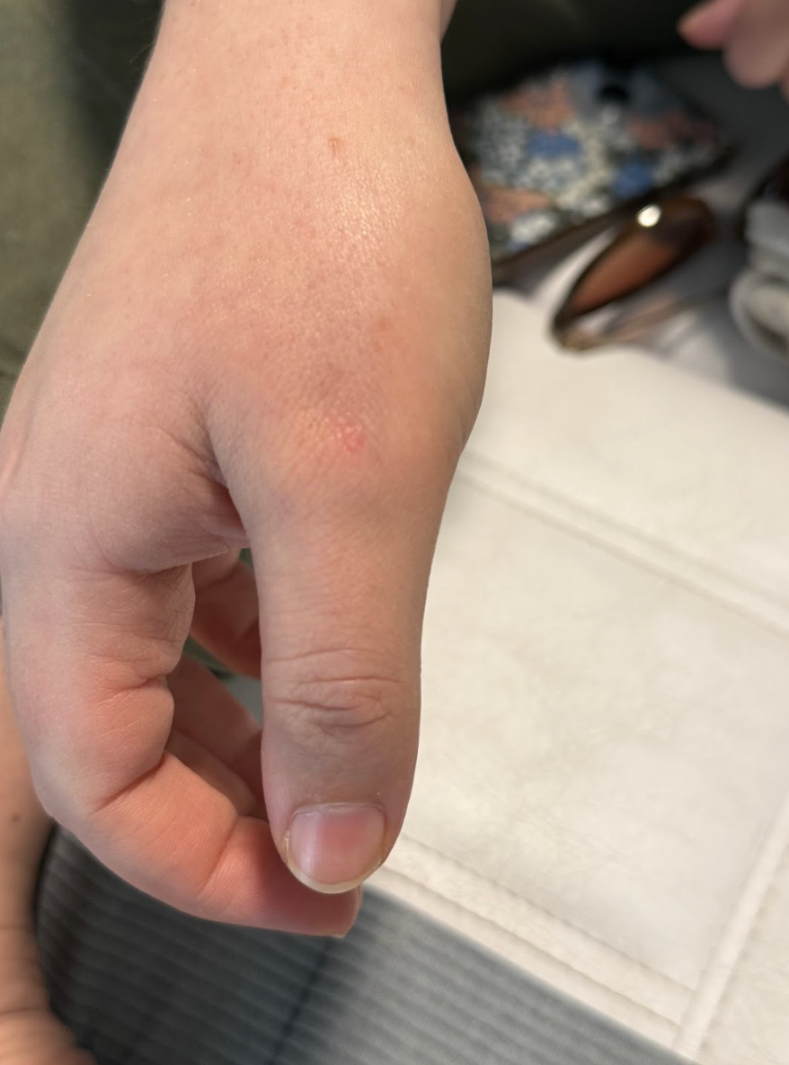 Close-up of a hand after a skin lesion removal treatment at KOZA Skin Clinic, Port Coquitlam, Tri-Cities BC.