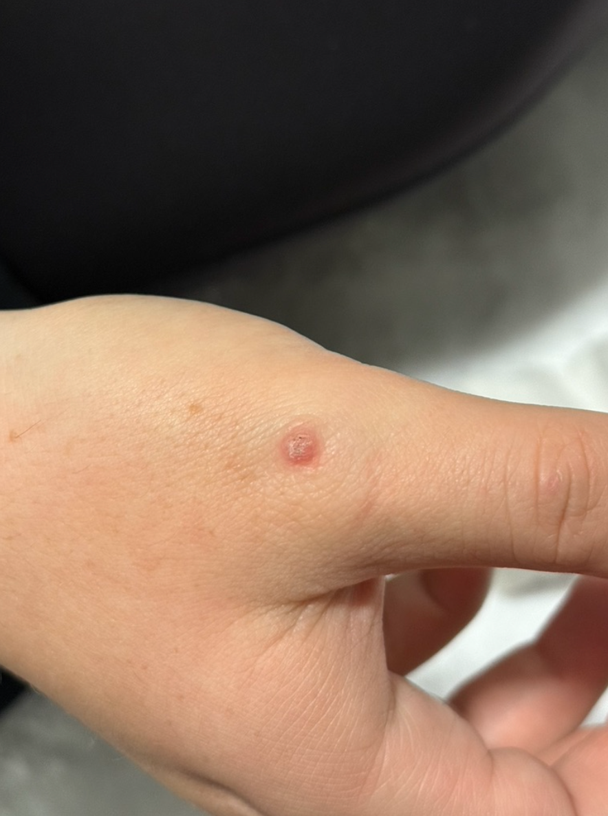 Close-up of the back of a hand before a skin lesion removal treatment at KOZA Skin Clinic, Port Coquitlam, Tri-Cities BC.
