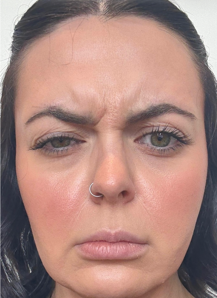 Client's face showing frown lines between the eyebrows before a wrinkle-relaxing treatment at KOZA Skin Clinic, Port Coquitlam, Tri-Cities BC.