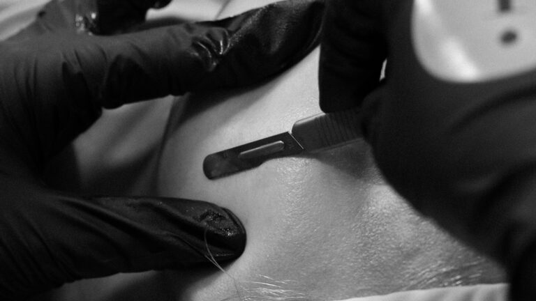 Dermaplaning Facial Port Coquitlam Port Moody Vancouver KOZA Skin Clinic