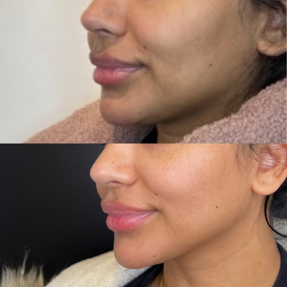 Morpheus8 Skin Resurfacing & Rejuvenation by KOZA Skin Clinic