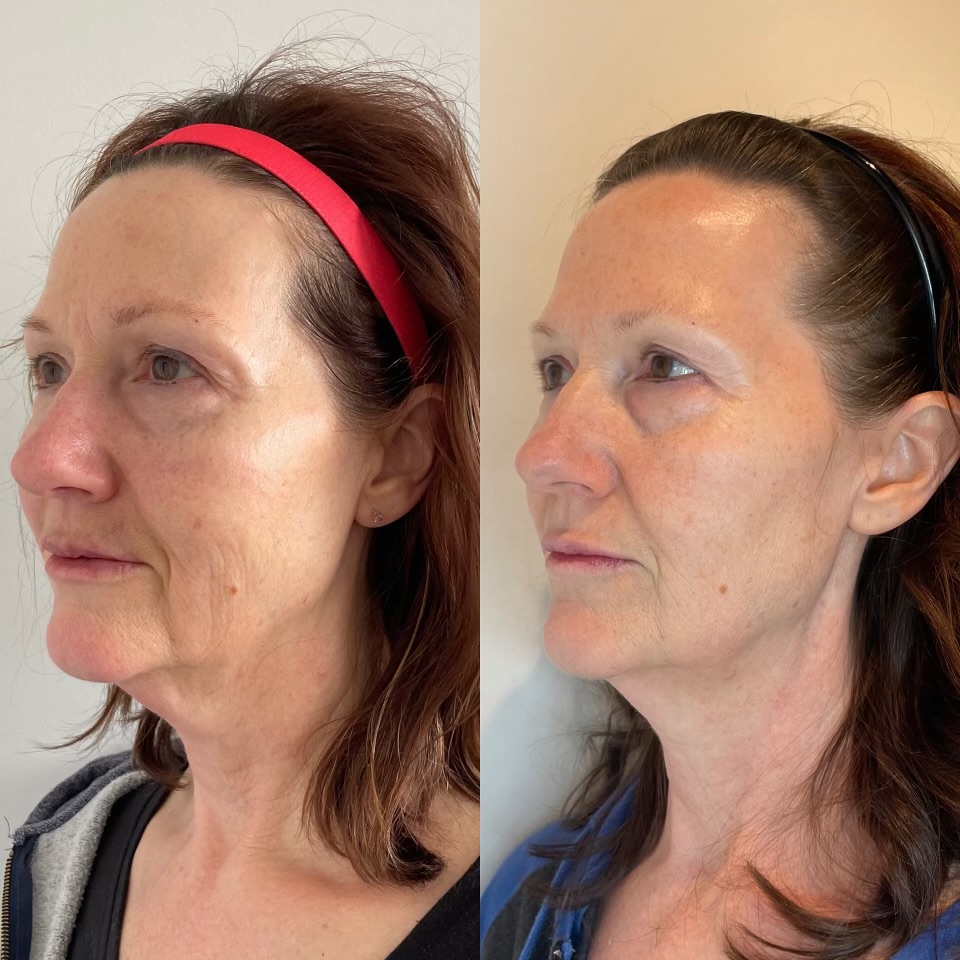 Morpheus8 Skin Resurfacing & Rejuvenation by KOZA Skin Clinic