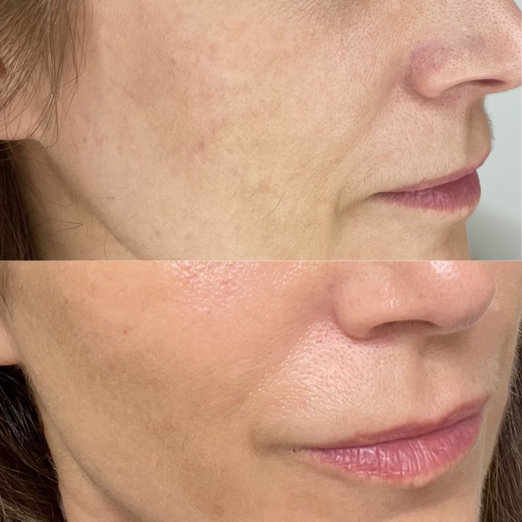 Morpheus8 Skin Resurfacing & Rejuvenation by KOZA Skin Clinic