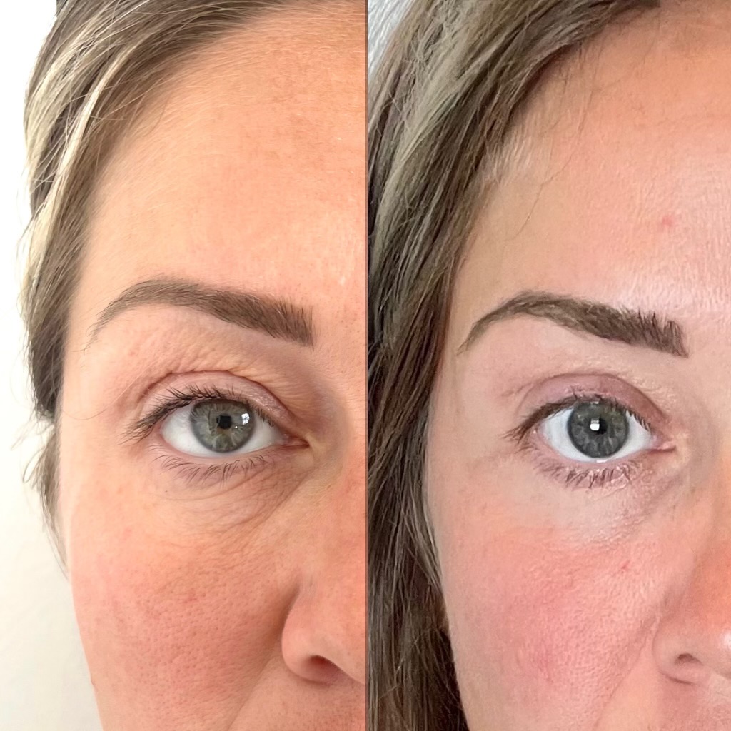Morpheus8 Skin Resurfacing & Rejuvenation by KOZA Skin Clinic